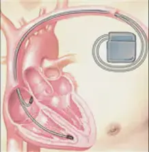 細(xì)數(shù)心臟起搏器和ICD之間的差異